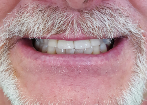 After dental crowns