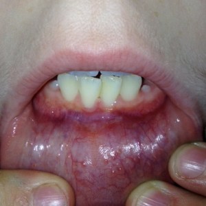 Three weeks after laser frenum detachment, completely healed