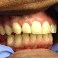 After: smile restored in one day with composite restorations.