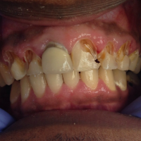 During: decay removed, teeth prepared for composite restorations