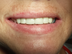 After: smile restored with six porcelain crowns