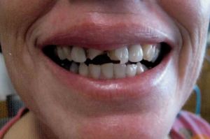 Before: fractured two front teeth caused by a fall