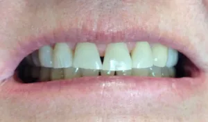 Before dental crowns