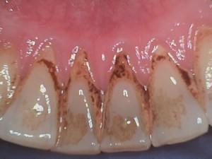 Before teeth cleaning