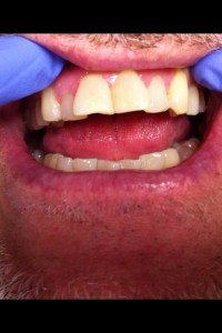 Before dental crowns