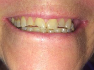 Before dental crowns