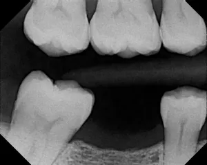X-ray after tooth extraction