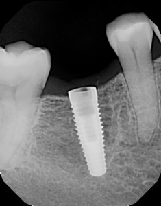 X-ray after dental implant placement