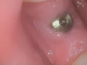 Dental implant placed in a patient's mouth