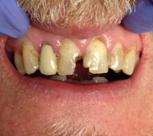 Before dental crowns