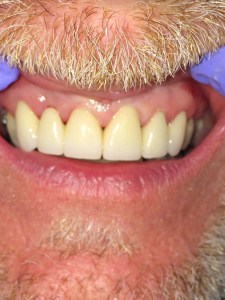 After dental crowns