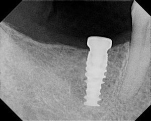 X-ray showing a placed dental implant