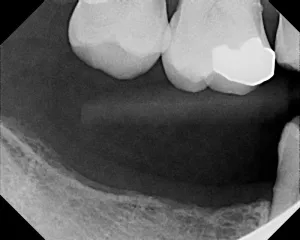 X-ray showing loss of molars due to decay and periodontal disease
