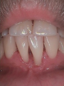 After teeth cleaning