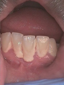 Before teeth cleaning