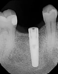 X-ray after dental implant placement