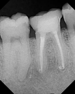 X-ray of a tooth that needs to be extracted