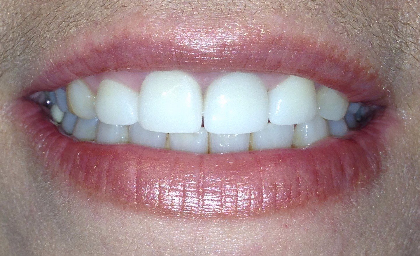 After dental crowns