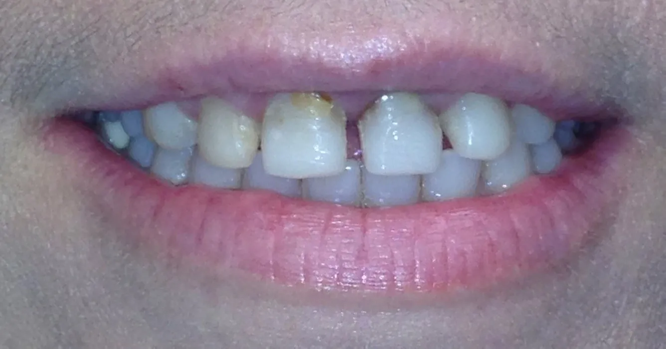 Before dental crowns