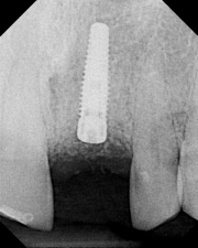 X-ray showing a placed implant