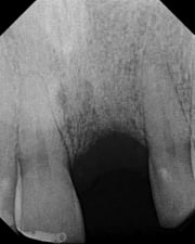 X-ray showing a missing front tooth