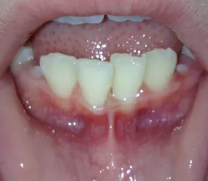 Before: girl with very tight frenum attachment between her lower teeth