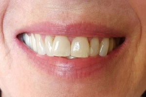 Before dental crowns