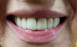 After dental crowns
