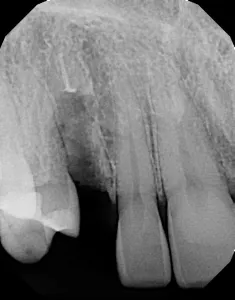 X-ray of tooth that has a broken root canal