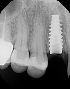 X-ray after extracting remaining root and placing a dental implant with a temporary crown