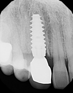 X-ray of a permanent dental crown placed 4 months later