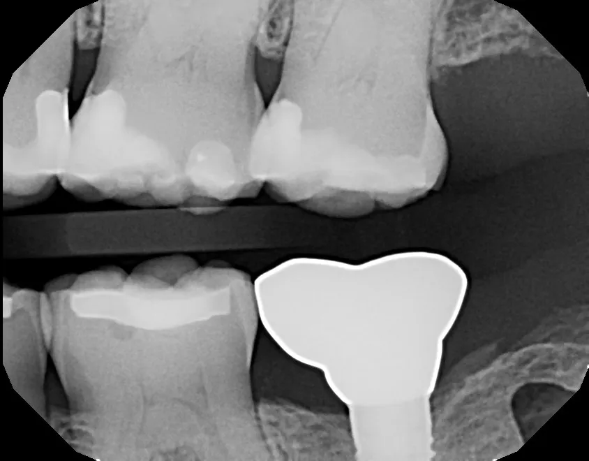 X-ray of dental crown permanently placed on the dental implant after healing
