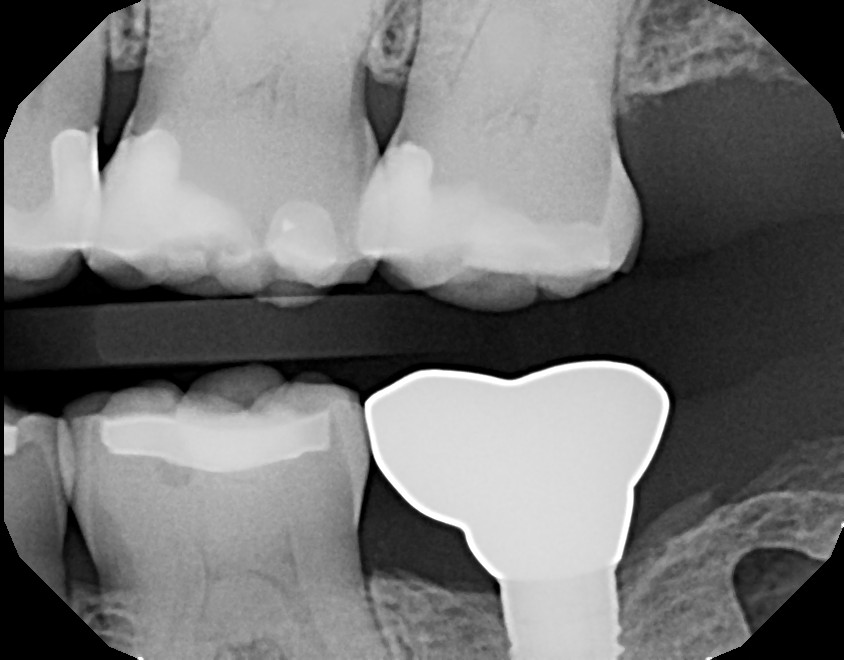 X-ray of dental crown permanently placed on the dental implant after healing