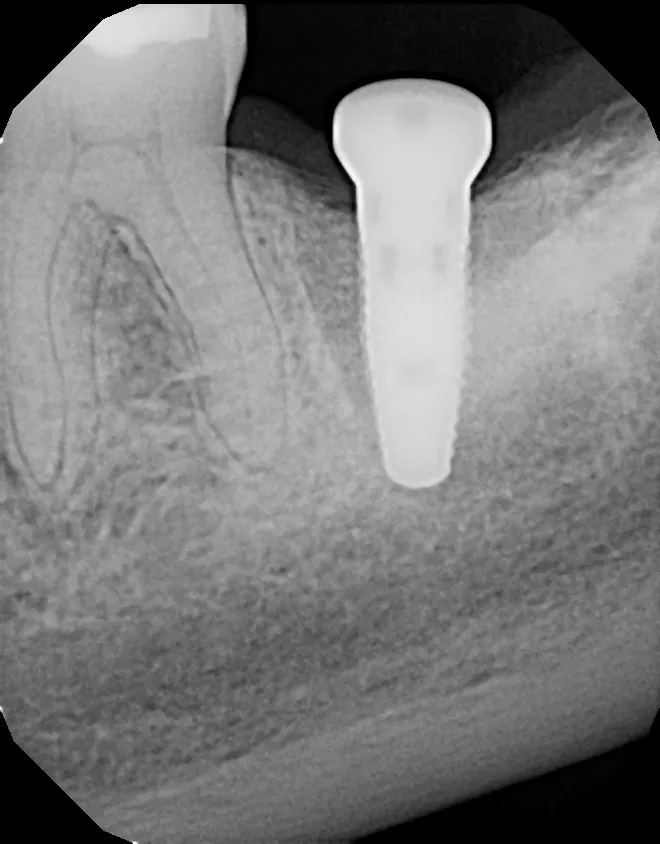 X-ray of placed dental implant