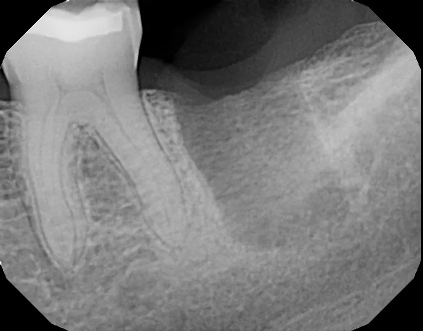 X-ray of tooth that was extracted, allowing time for bone to fill in