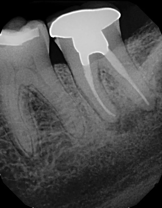 X-ray of tooth needing repair after a fractured root