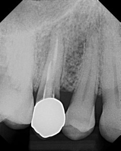 X-ray of non-restorable tooth