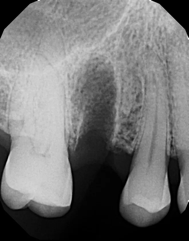 X-ray of bone grafting after tooth extraction