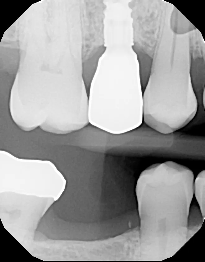 X-ray of dental implant placed instead of a dental bridge