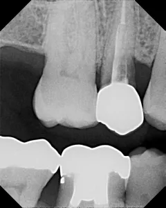 X-ray of tooth with decay under crown
