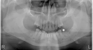 X-ray of all molars missing due to periodontal disease