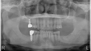 X-ray of two dental implants placed to replace molars