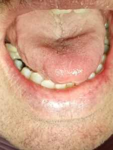 After: wart removed from tongue
