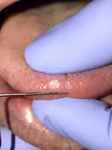 During: wart extraction on tongue