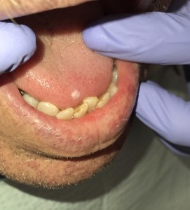 Before: wart on tongue