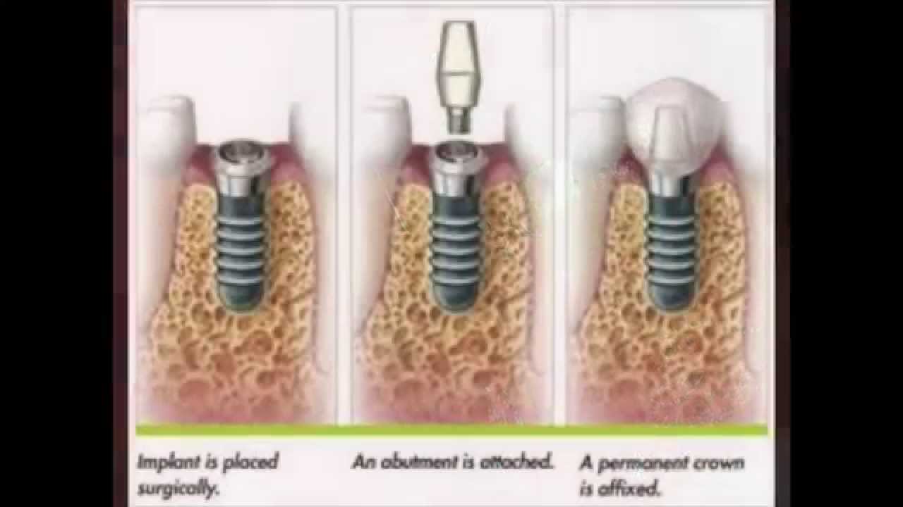 Dental Implant Video Thumbnail