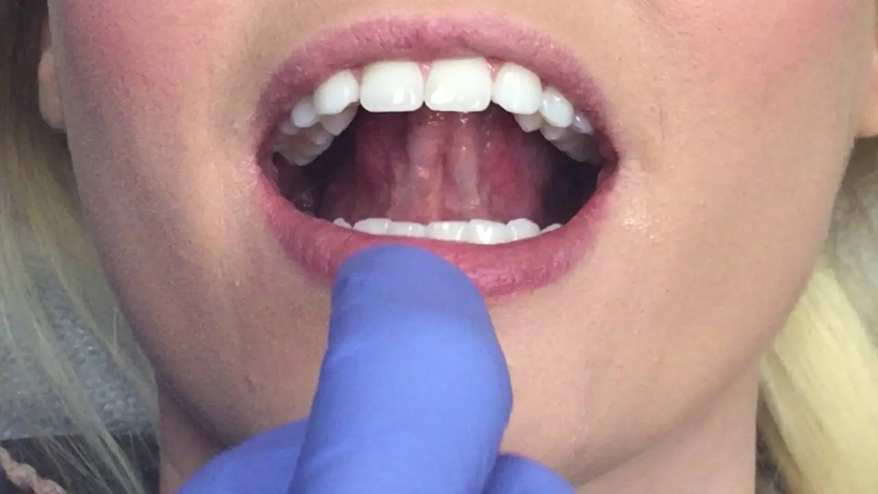 Oral Cancer Screening Video Thumbnail